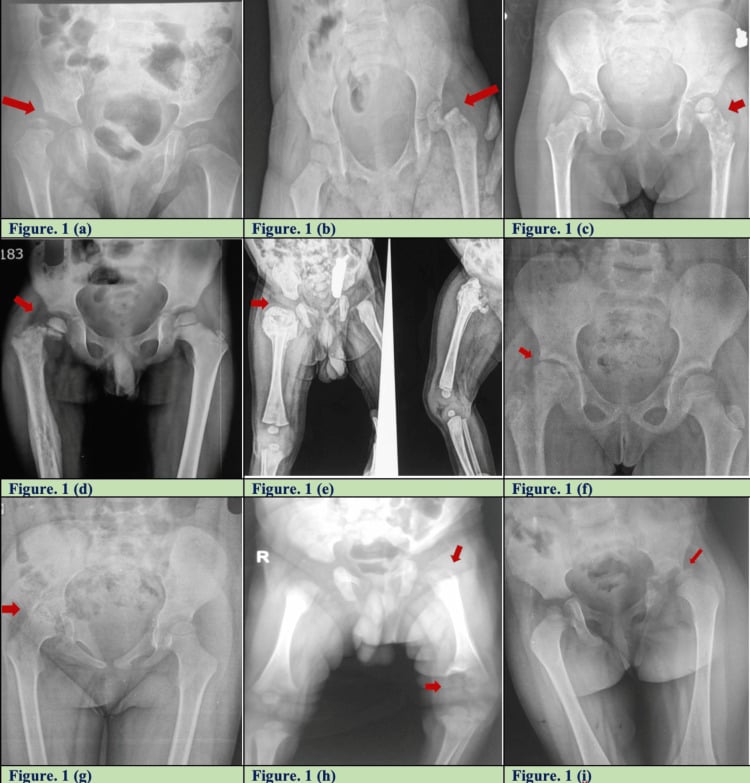 Nine radiographs, panels a to i, with red arrows marking varied late sequelae of paediatric septic arthritis of the hip.