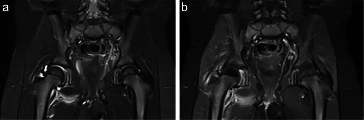 Coronal STIR (a) and post-contrast (b) MRI showing a right septic hip effusion, adductor oedema and decreased femoral-head enhancement.