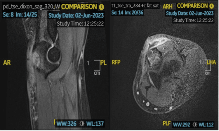 MRI of the elbow showing a rim-enhancing subcutaneous collection eroding into the olecranon with marrow oedema signal