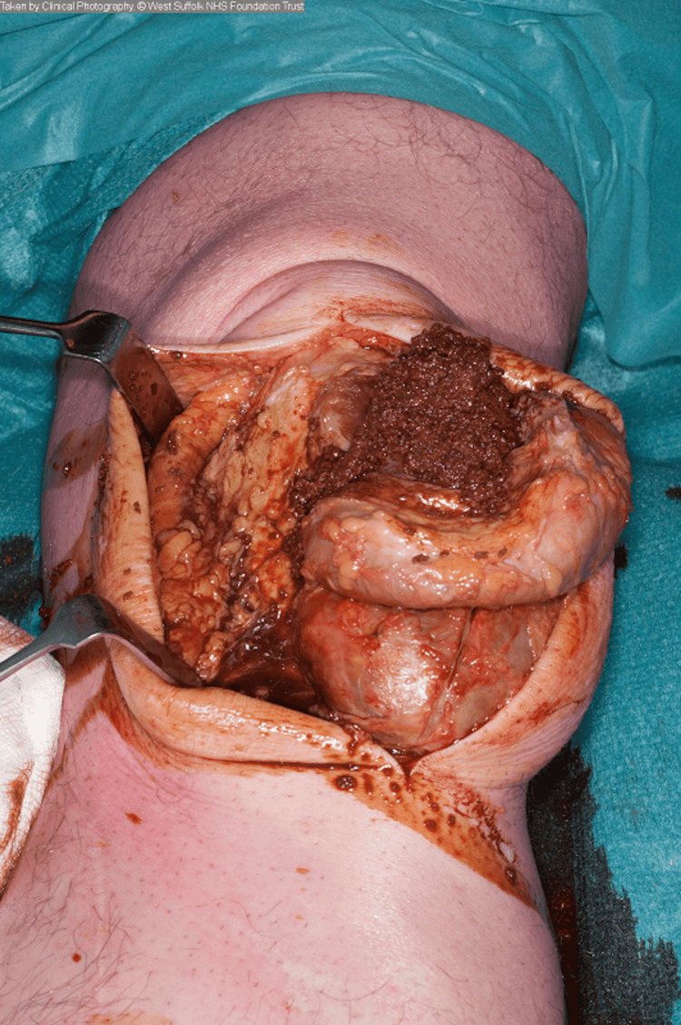 Intra-operative photograph of a dissected prepatellar bursal cyst containing chocolate-coloured old blood