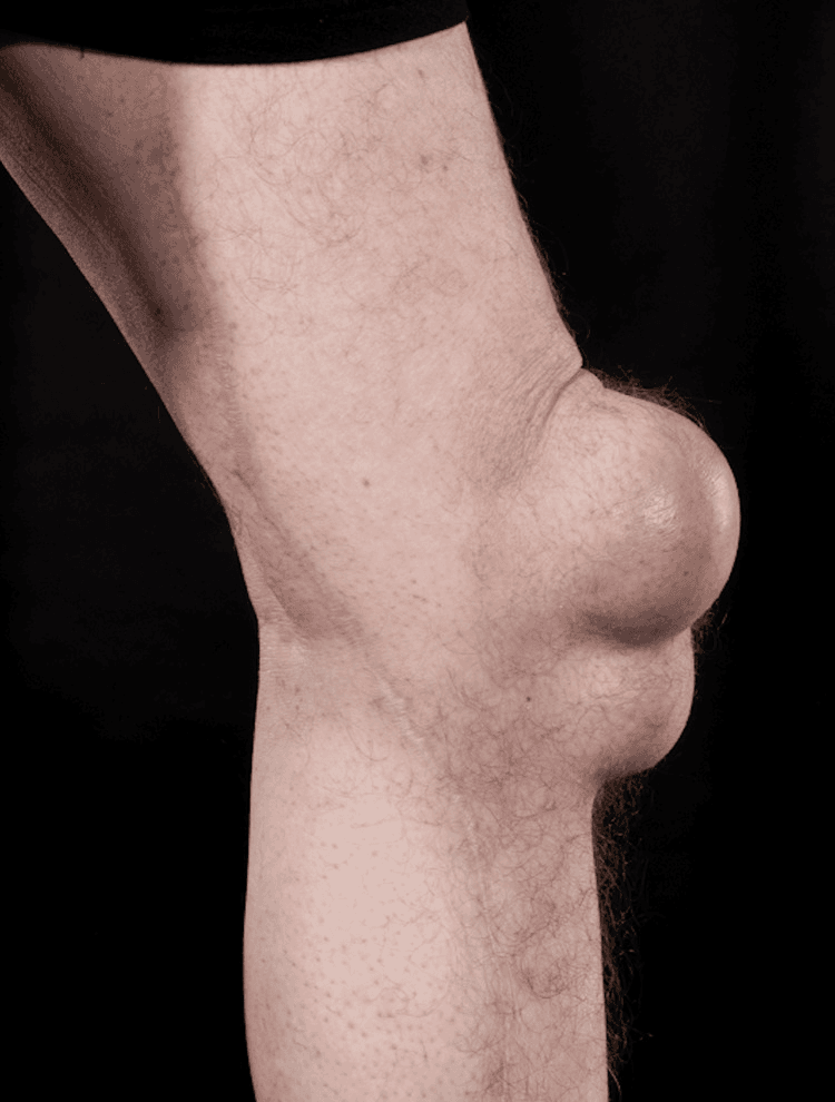 Profile photograph of massive prepatellar swelling of the knee