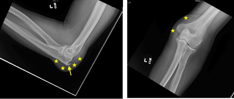 Elbow radiographs showing an olecranon spur and a fluid-filled bursa outlined by soft-tissue swelling
