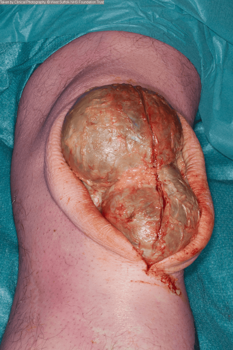 Intra-operative photograph following complete excision of a prepatellar bursa showing the underlying patella and patellar tendon