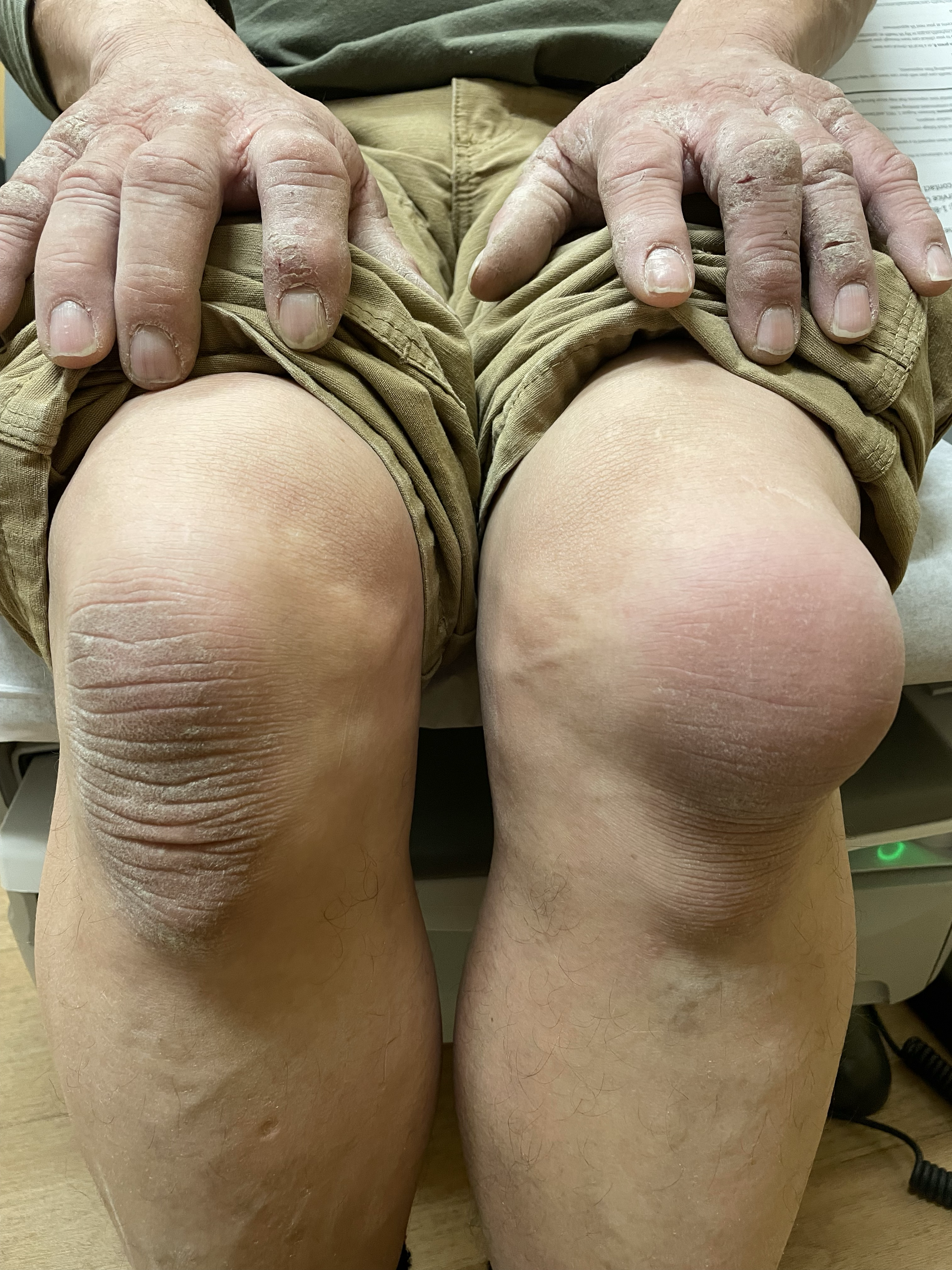 Photograph of prepatellar bursitis in a retired concrete finisher with the unaffected knee for comparison