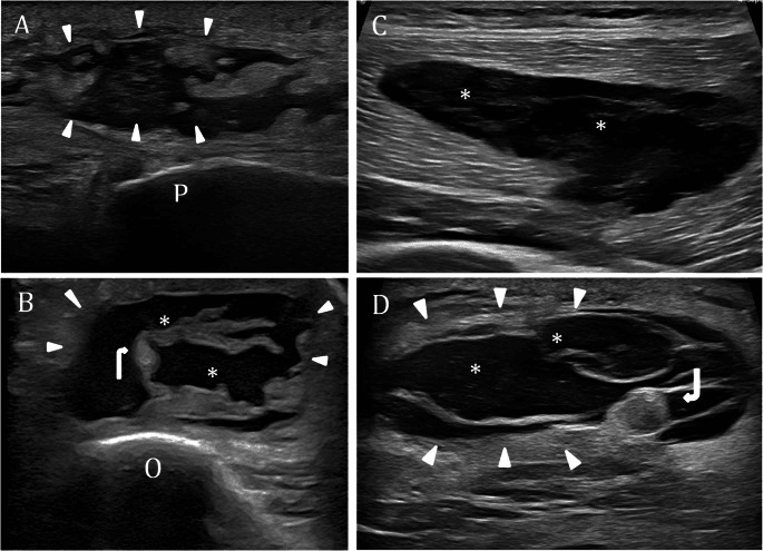 Short-axis ultrasound images showing a distended anechoic prepatellar bursa and a distended olecranon bursa