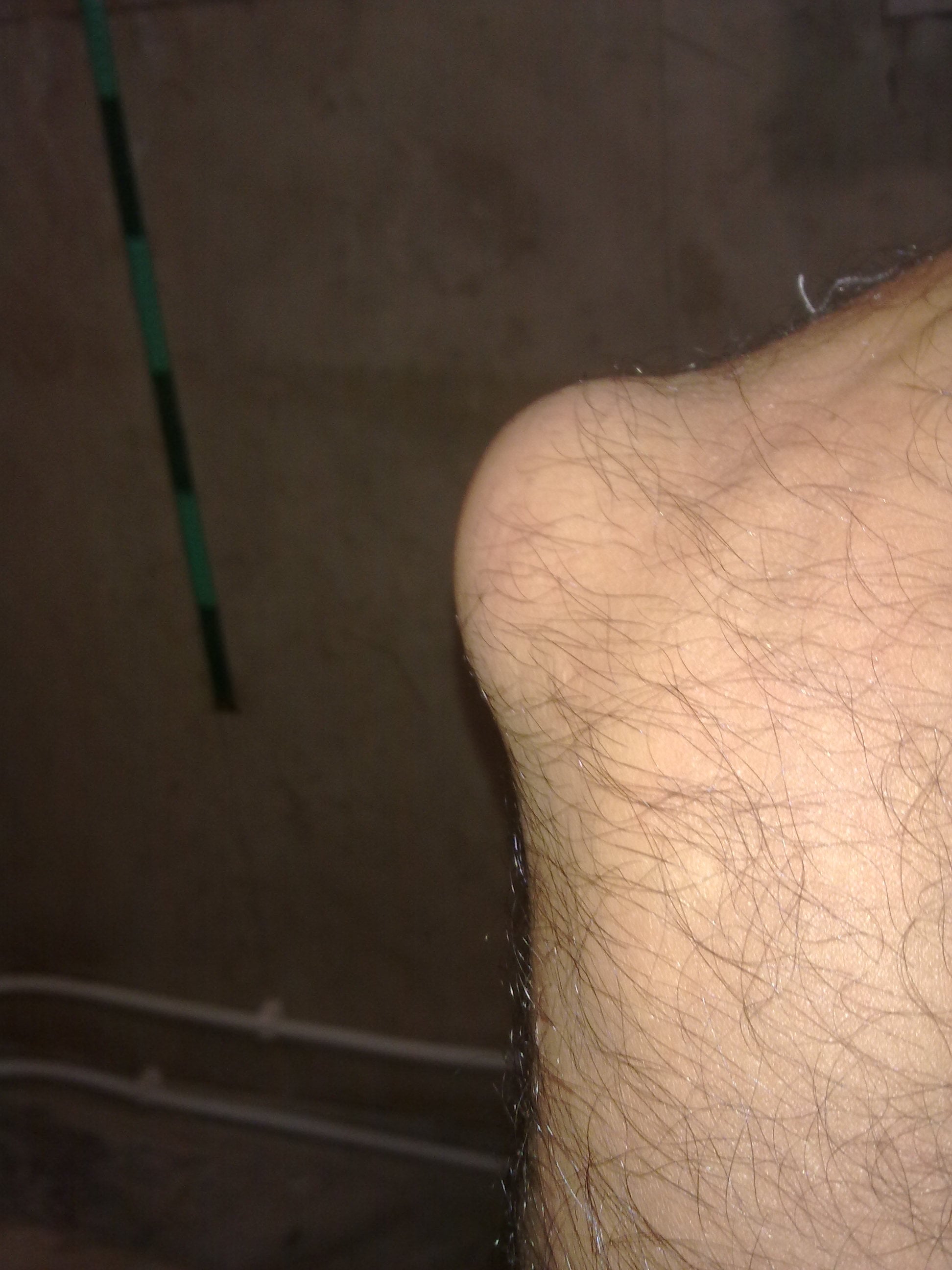 Clinical photograph of olecranon bursitis showing a soft fluid-filled swelling over the tip of the elbow