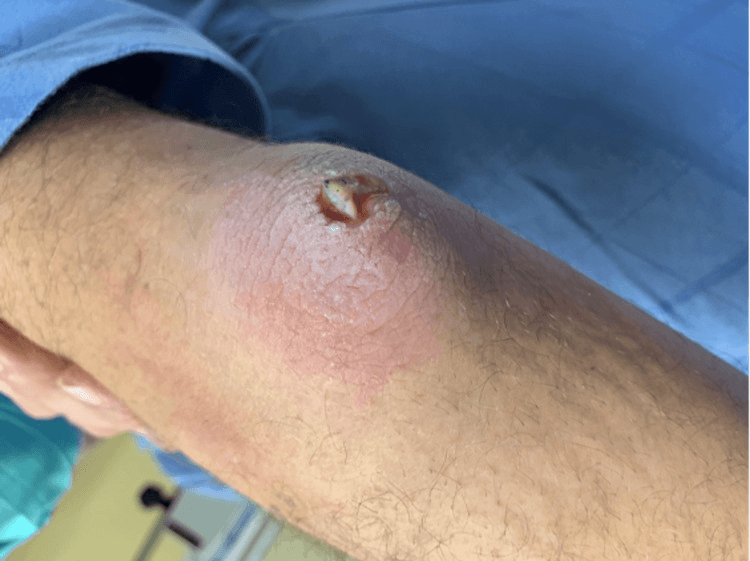 Clinical photograph of a swollen elbow with a small crusted punctum in olecranon bursitis after minor trauma