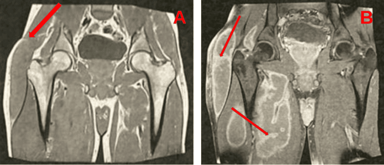 Coronal MRI of the hip showing a trochanteric bursal collection with enhancing parietal villosities in tuberculous bursitis