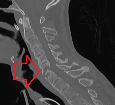 Sagittal CT of an ankylosed cervical spine showing a transverse fracture through the fused column