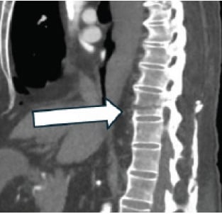 Sagittal CT angiogram cropped to the thoracolumbar spine showing a T11 chalk-stick fracture through an ankylosed column