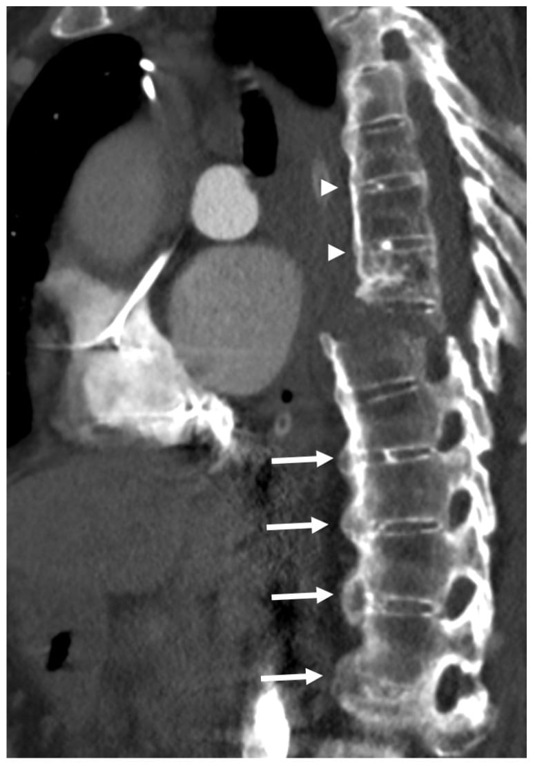 Sagittal thoracic CT of DISH after low-energy trauma showing an unstable extension-type fracture through the fused column