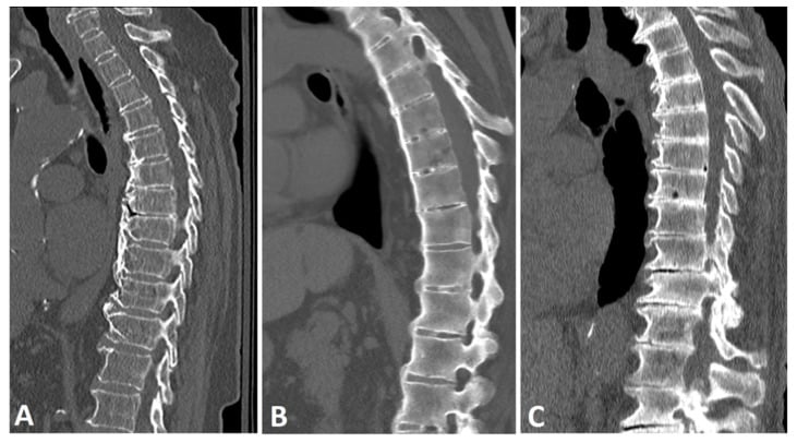 Three sagittal thoracic CT reconstructions comparing flowing chunky DISH osteophytes with thinner bridging and mixed patterns