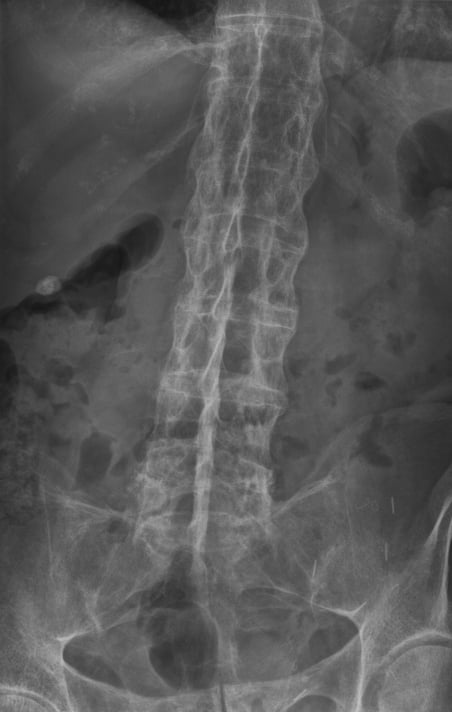 Radiograph of the lumbar spine showing bamboo spine with bridging syndesmophytes in ankylosing spondylitis