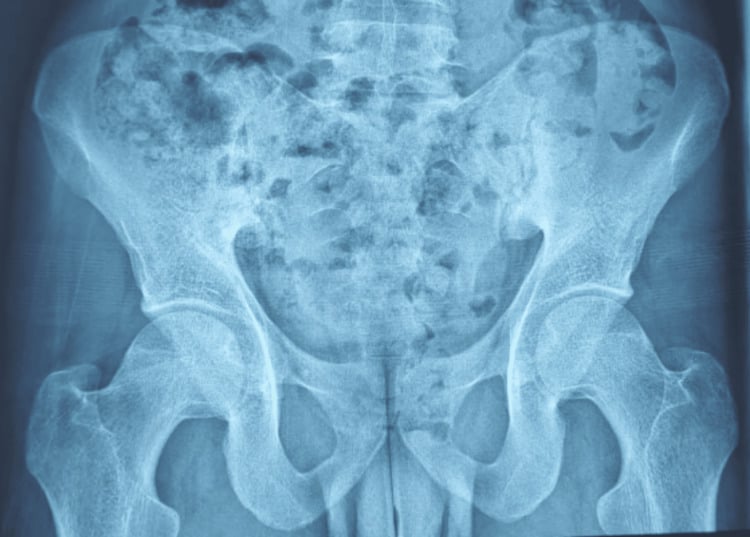 AP pelvis radiograph showing bilateral grade-III sacroiliitis with iliac sclerosis and irregular joint margins