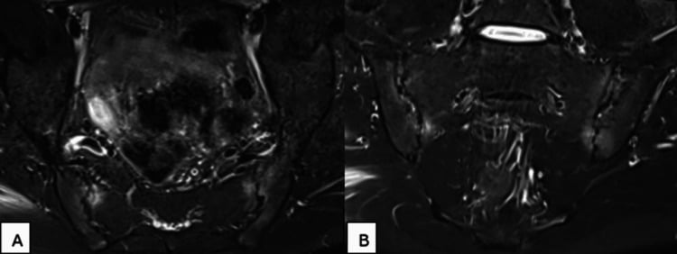 Axial and coronal STIR MRI of the sacroiliac joints showing subchondral marrow oedema with erosions