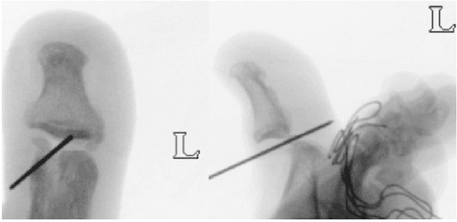 AP and lateral radiographs of the great toe showing wire fixation in the region of the hallux sesamoid complex.