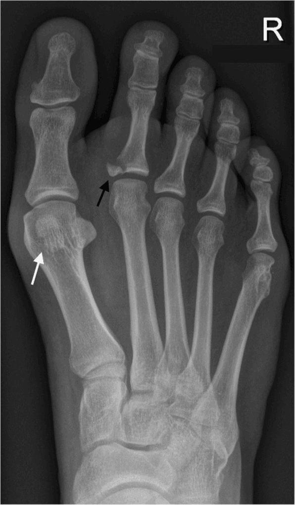 AP radiograph of the right foot with arrows at a bipartite medial hallux sesamoid and a second-toe proximal-phalanx fracture