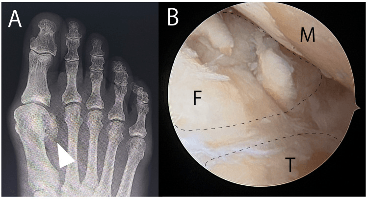Radiograph and arthroscopic view of fragmented fibular sesamoid osteonecrosis