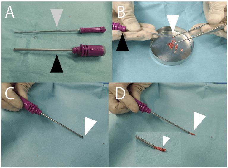 Hooded burr system for delivering autologous graft into a sesamoid nonunion