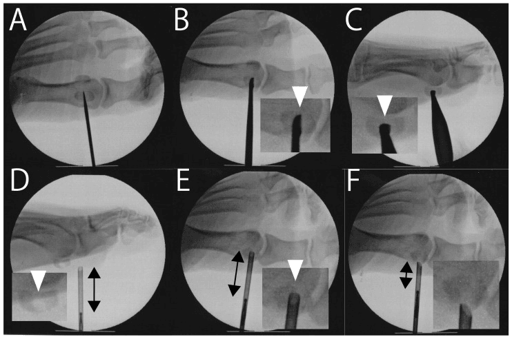 Fluoroscopic debridement and autologous grafting of hallux sesamoid nonunion