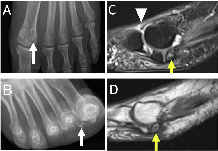 AP radiograph, sesamoid view and MRI of hallux sesamoid osteonecrosis with a fragmented lateral sesamoid