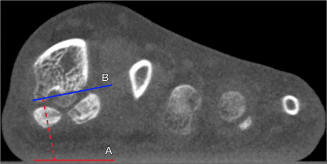 Weight-bearing CBCT measurement of first metatarsal pronation through the sesamoid sulci
