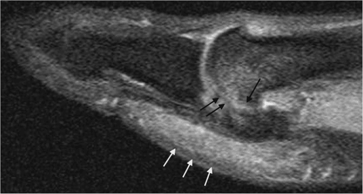 Sagittal MRI of the first metatarsophalangeal joint in sesamoiditis with arrows at the sesamoid-metatarsal articulation and the plantar soft tissues