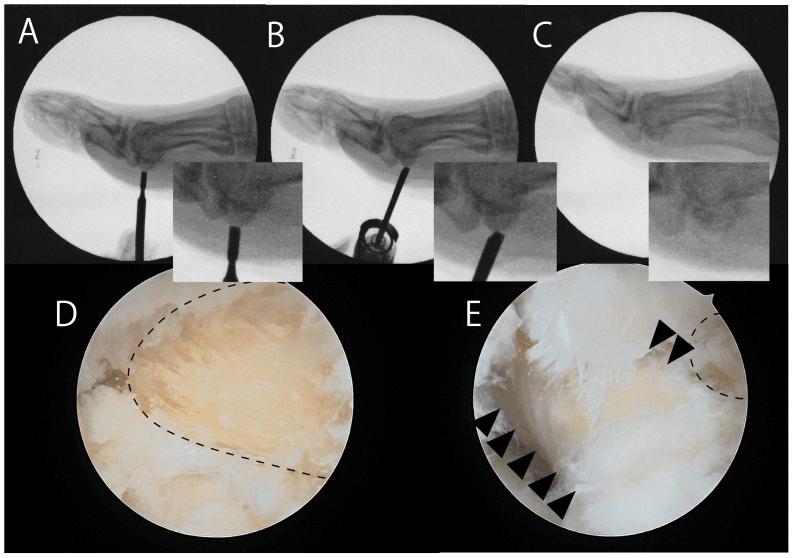 Fluoroscopic and endoscopic sequence of tibial sesamoid shaving