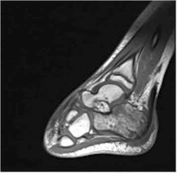 Sagittal MRI of a paediatric foot demonstrating calcaneal osteomyelitis.