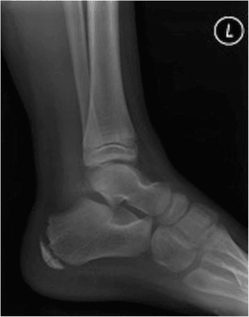 Lateral radiograph from a child with calcaneal osteomyelitis showing a sclerotic and fragmented calcaneal apophysis.