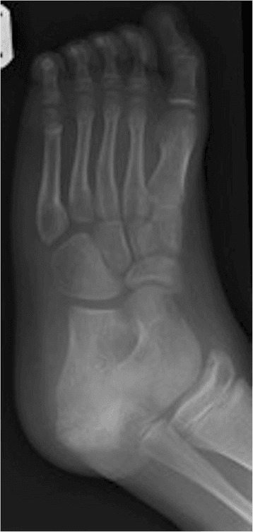 Oblique radiograph of a skeletally immature foot showing open physes and normal developmental ossification.