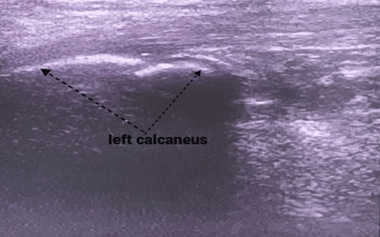 Longitudinal ultrasound of the left heel showing fragmentation of the calcaneal apophysis.