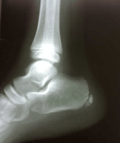 Lateral radiograph of a skeletally immature ankle showing sclerosis and fragmentation of the posterior calcaneal apophysis.