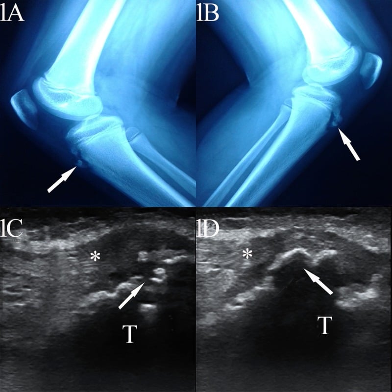 Bilateral knee radiographs and longitudinal ultrasound images showing Osgood-Schlatter traction apophysitis at the tibial tubercles.