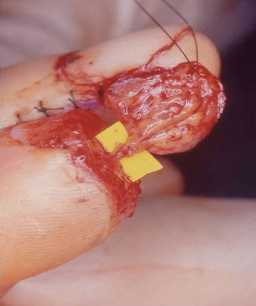 Fingertip crush injury context for nail-bed and distal phalanx assessment