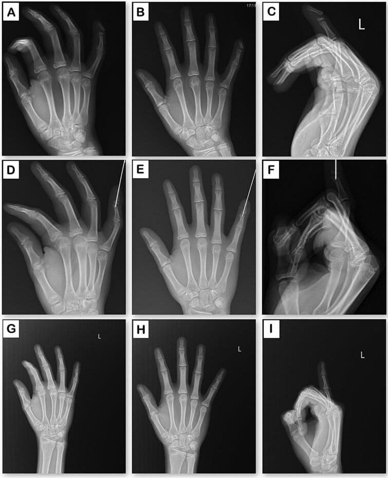 Clinical sequence of a paediatric Seymour fracture before treatment, after surgery and at 10-month follow-up