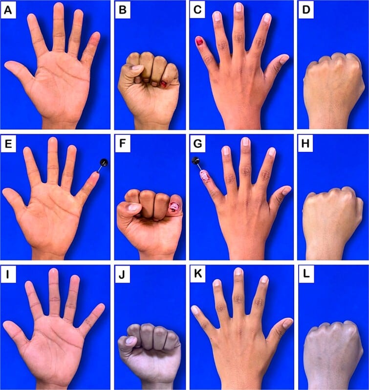 Serial oblique, anteroposterior and lateral radiographs of a Seymour fracture before treatment, after fixation and at follow-up