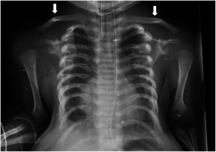 Neonatal chest radiograph in Jeune syndrome showing a narrow, elongated thorax with high-riding clavicles and short horizontal ribs
