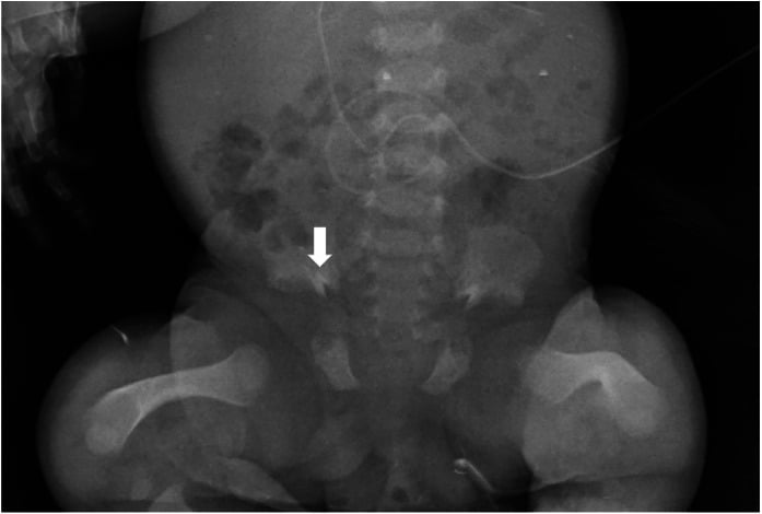 Pelvic radiograph in Jeune syndrome showing trident-shaped acetabula, flared iliac bones, and shortened femora