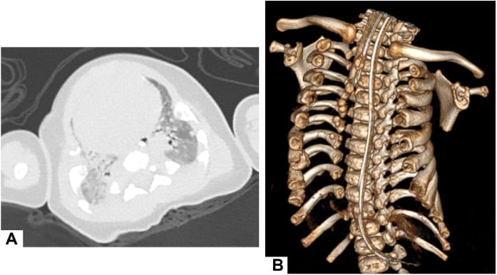 Axial chest CT image demonstrating a narrow thoracic cage and pulmonary atelectasis in Jeune syndrome