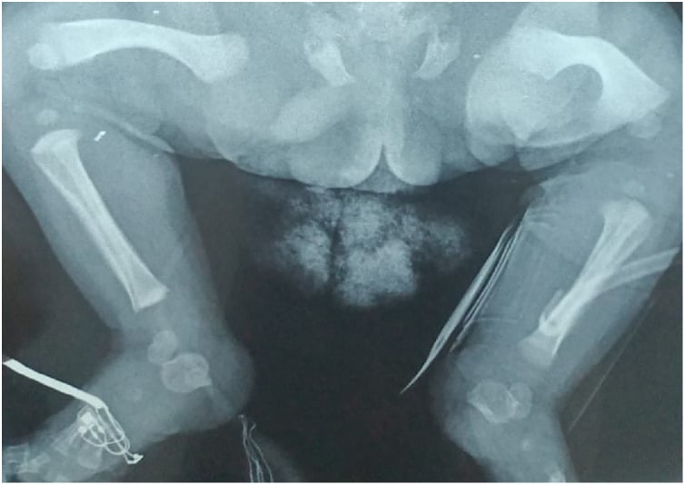 Radiograph of lower extremities demonstrating rhizomelic long bone shortening in Jeune syndrome