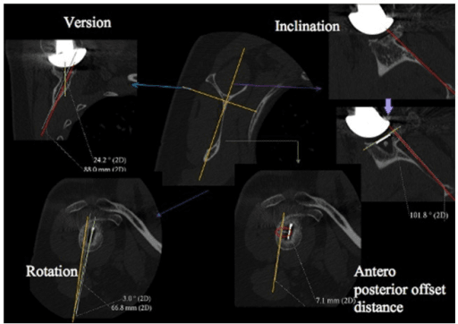 CT images showing the four glenoid component positioning parameters