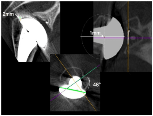 CT images showing humeral head component positioning parameters