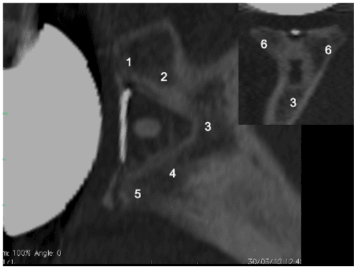 CT scan showing Mole Score zones for glenoid radiolucent line assessment