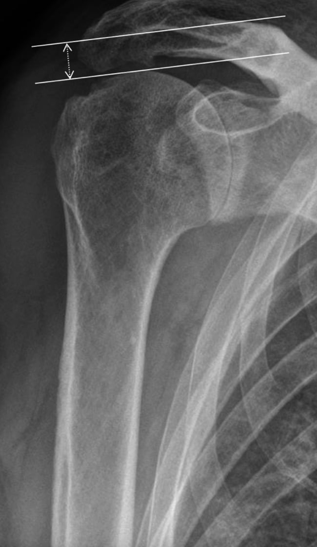 Anteroposterior radiograph demonstrating acromiohumeral distance measurement