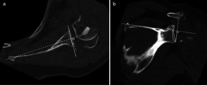 Axial and coronal CT showing Friedman glenoid version and Boileau reverse shoulder arthroplasty inclination measurements
