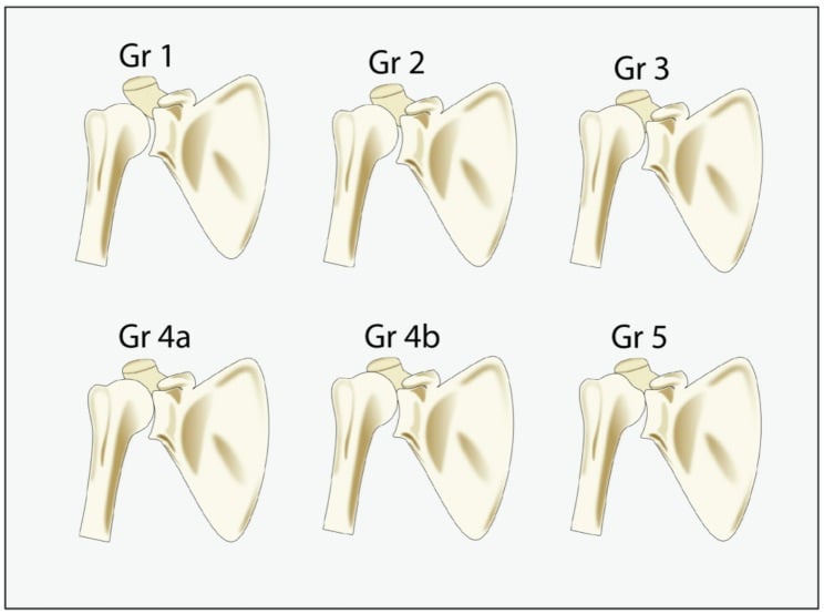 Six-panel schematic of Hamada grades 1 through 5 for cuff tear arthropathy