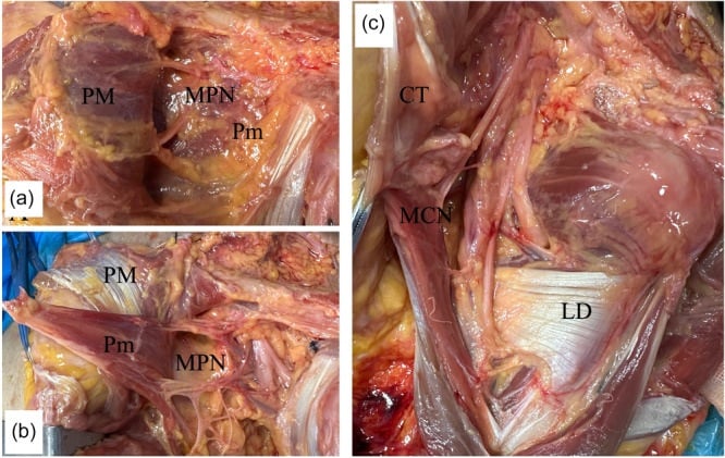 Cadaveric panels showing medial pectoral nerve branches and the musculocutaneous nerve beneath coracobrachialis