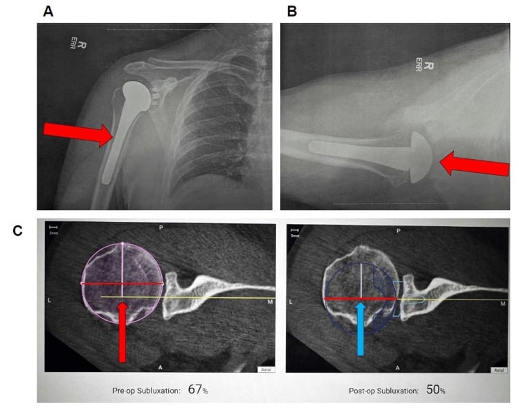 Postoperative AP and axillary radiographs of an anatomic total shoulder arthroplasty with planning overlays