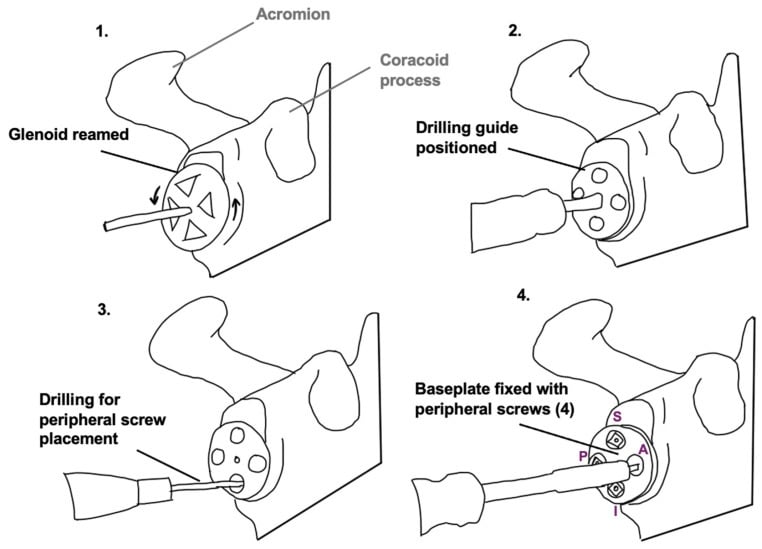 Four-step schematic of reverse shoulder glenoid reaming guide placement drilling and baseplate fixation